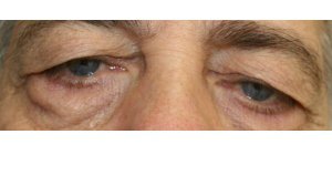 Manhattan BLEPHAROPLASTY Before 5